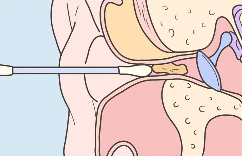 swabs push the earwax further down the ear canal