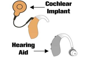 Hearing Aids vs. Cochlear Implants